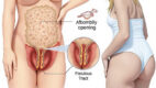 Anorectal Malformations (Imperforate Anus)